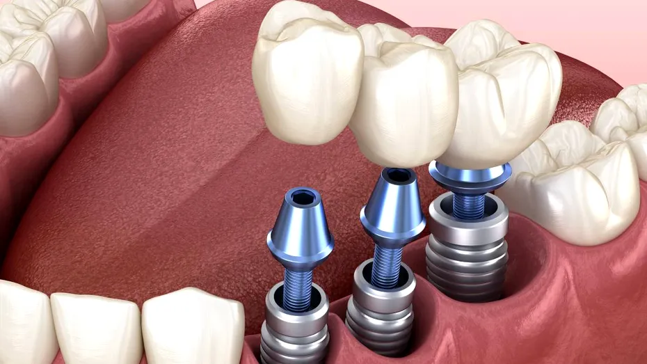 Dinți ficși în 24 de ore: ce este adevărat și ce trebuie să știe pacienții înainte de un implant dentar