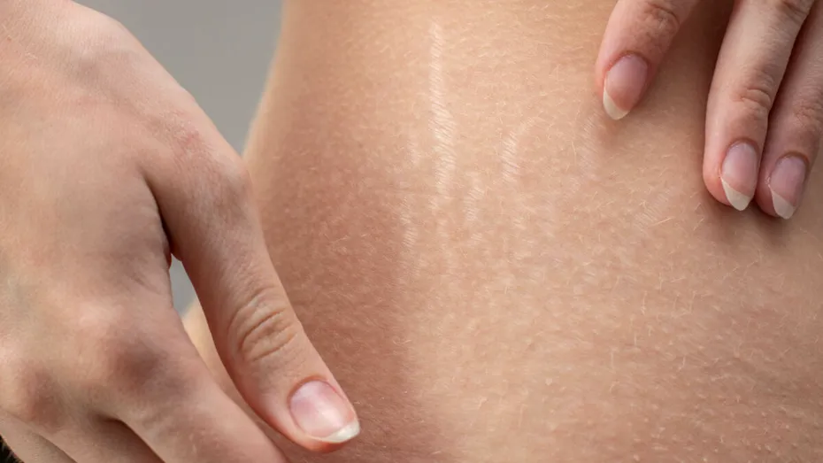 Vergeturile nu dispar complet, dar pot fi estompate. Ce tratamente recomandă dermatologii și care sunt doar mituri